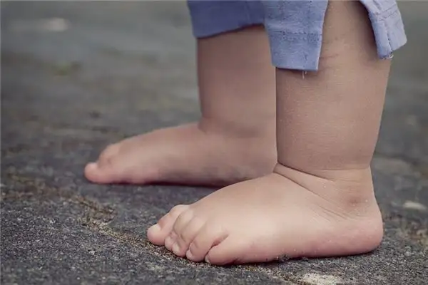 Dream Interpretation Swollen Feet Meaning on NuvoraDream